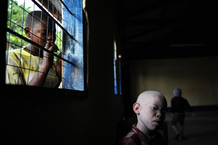 Los niños albinos no son libres en África, viven en prisiones para protegerse de la sociedad.