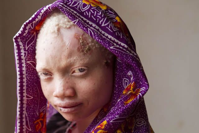 albinos tanzania 15