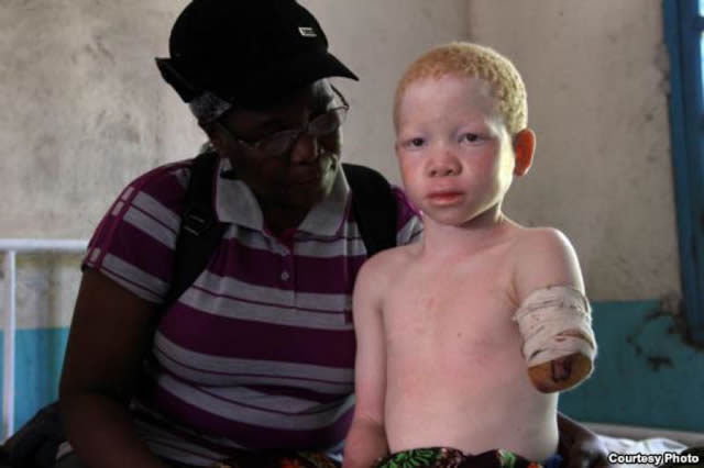 albinos tanzania 16