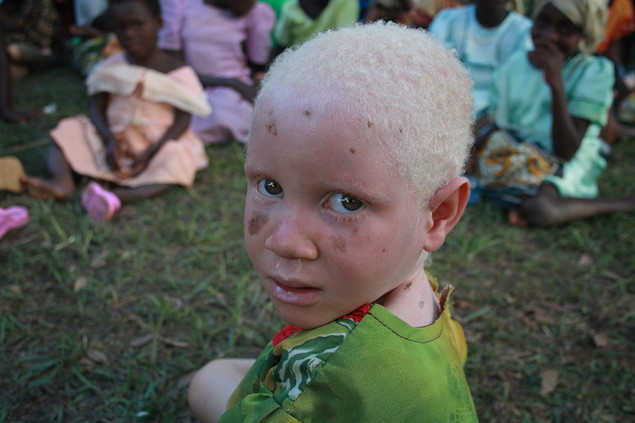albinos tanzania 5