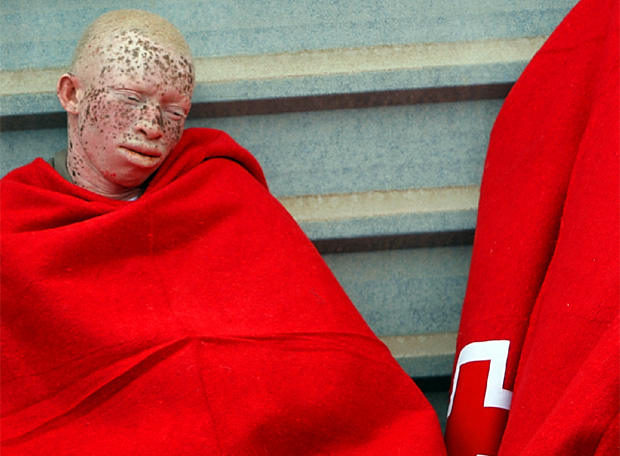 Algunos albinos lo arriesgan todo en busca de un vida segura.